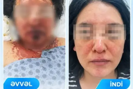 Bakıda dərmandan Layell sindromu keçirən qadın sağalıb